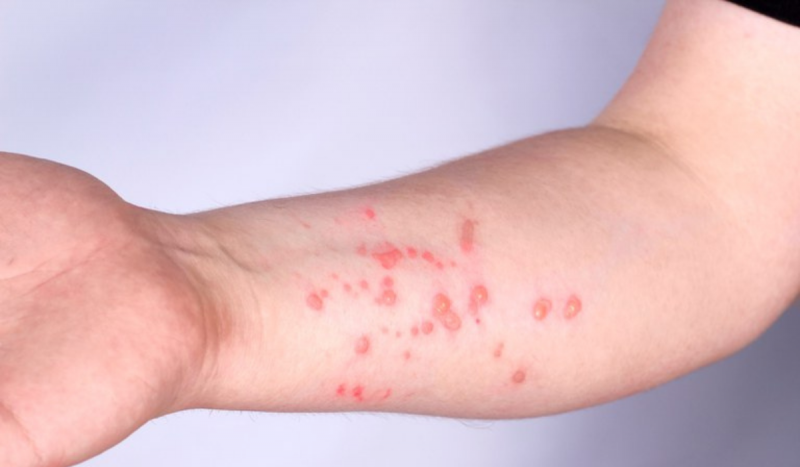 pele de pessoa com mpox 800x467